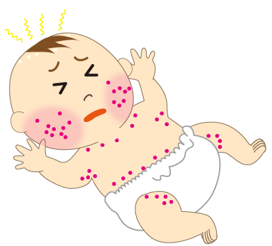 小児にかかりやすい病気「乳児湿疹」